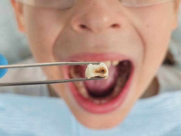Best Emergency Tooth Extraction in Sebastian, FL